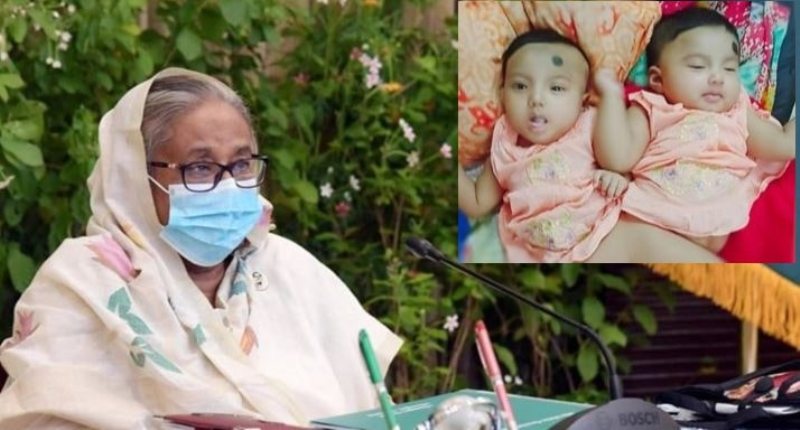 Conjoined twins to be separated, Prime Minister Hasina to take care of treatment cost